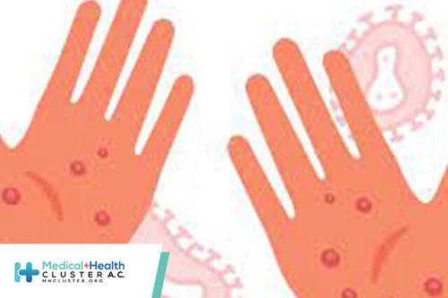 آبله میمونی برای چه افرادی خطرناک تر است؟