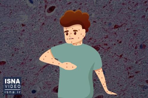 ویدیو، بحران شیوع سرخک در اتحادیه اروپا