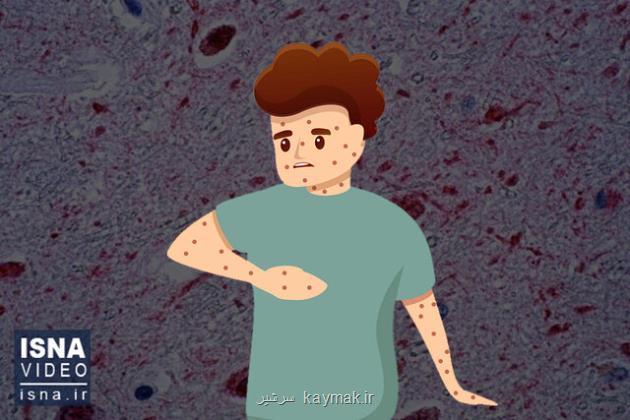 ویدیو، بحران شیوع سرخک در اتحادیه اروپا