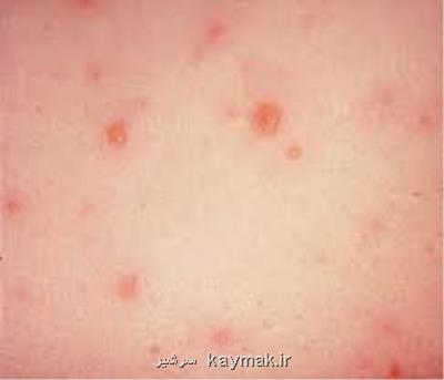 خطرات مبتلاشدن به آبله مرغان در دوران حاملگی